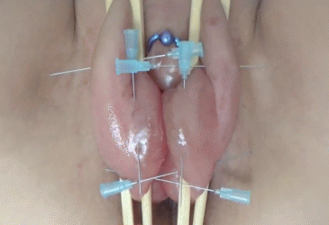 Labios vaginales hinchados con succionador
